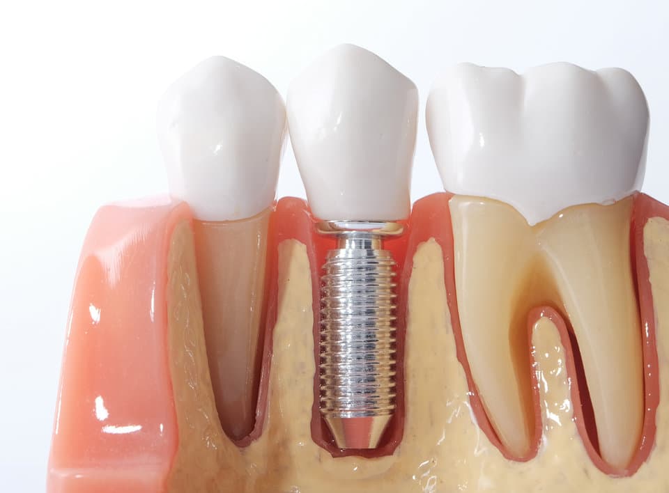 מודל שתל דנטלי — שתלים דנטליים